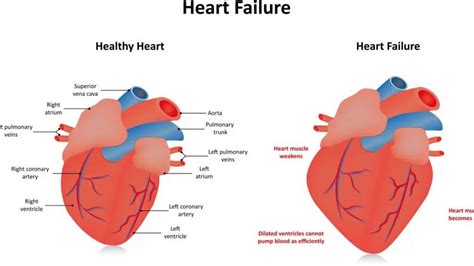 hypokinesis of left ventricle cause